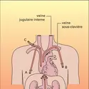 Nutrition artificielle : accès veineux - crédits : Encyclopædia Universalis France