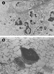 Atteintes pulmonaires et pancréatiques de la mucoviscidose - crédits : Claude Ferec/ INSERM