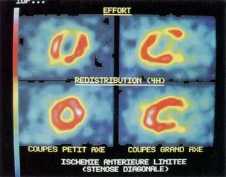 Fixation d'un radiotraceur (thallium 201) lors de l'irrigation sanguine du myocarde - crédits : service de médecine nucléaire, hôpital du Haut-Lévêque, Pessac, Gironde