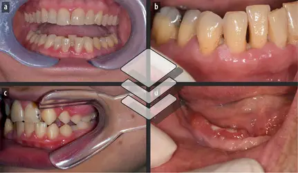 Maladies associées au microbiote buccal - crédits : Ihsène Taïhi-Nassif