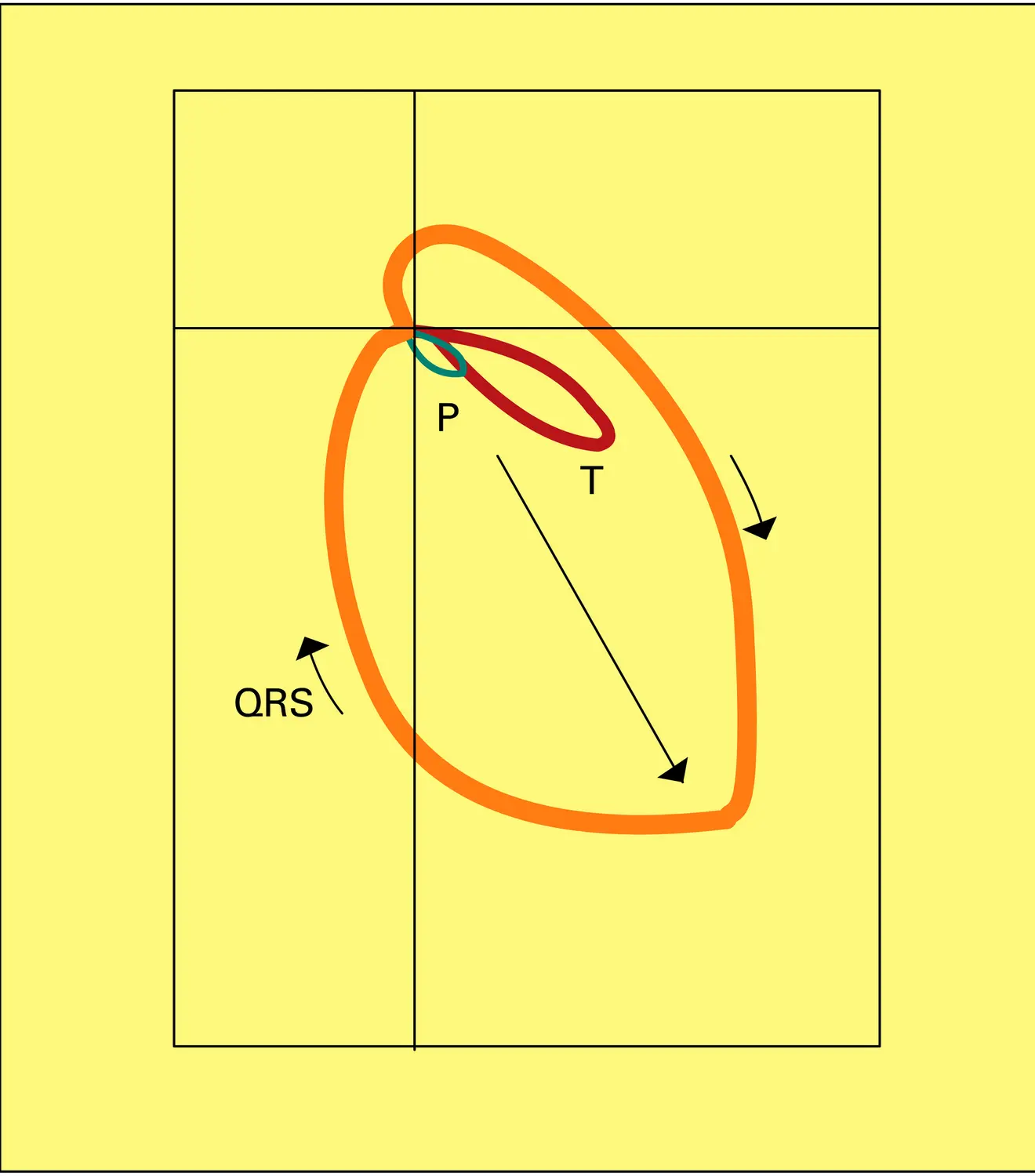 Triangle d'Einthoven - vue 2