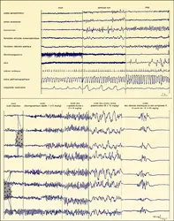 Sommeils physiologique et anesthésique - crédits : Encyclopædia Universalis France