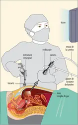 Principe de la chirurgie mini-invasive - crédits : Encyclopædia Universalis France