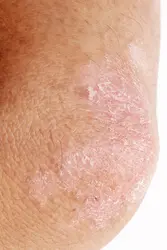 Psoriasis - crédits : Phasinphoto/ Shutterstock