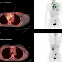 Examen T.E.P./T.D.M. d'un lymphome - crédits : service de médecine nucléaire, hôpital du Haut-Lévêque, Pessac, Gironde