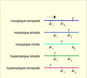 Astigmatismes oculaires - crédits : Encyclopædia Universalis France