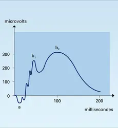 Électrorétinogramme - crédits : Encyclopædia Universalis France