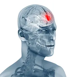 Reconstitution en 3D d'une tumeur cérébrale chez l'homme - crédits : S. Kaulitzki/ Shutterstock