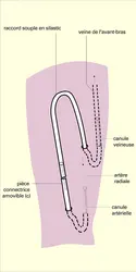 Quinton-Scibner : court-circuit artério-veineux - crédits : Encyclopædia Universalis France