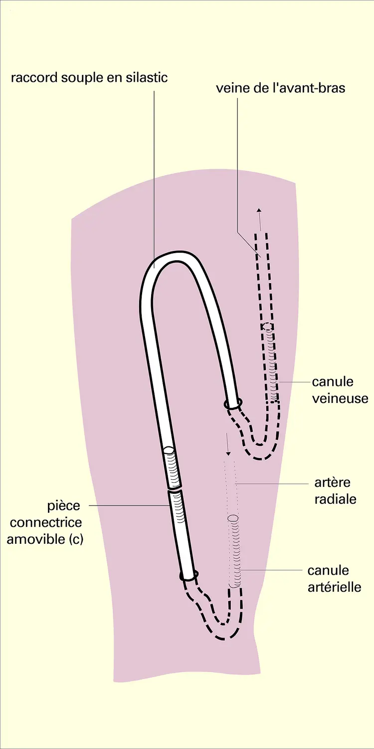 Quinton-Scibner : court-circuit artério-veineux