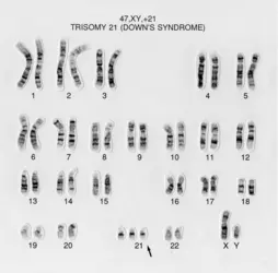 Identification d’une trisomie 21 - crédits : Wessex Reg. Genetics Centre/ Wellcome Collection (CC BY)