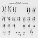 Identification d’une trisomie 21 - crédits : Wessex Reg. Genetics Centre/ Wellcome Collection (CC BY)