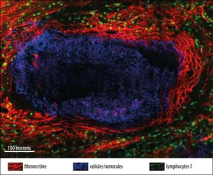  Lymphocytes T dans une tumeur pulmonaire humaine - crédits : Emmanuel Donnadieu