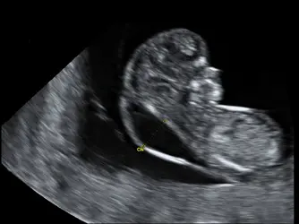 Clarté nucale chez un fœtus humain - crédits : Phanie/ AFP