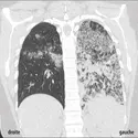 Image radiologique d’une tuberculose pulmonaire - crédits : Grand hôpital de Charleroi, Belgique 