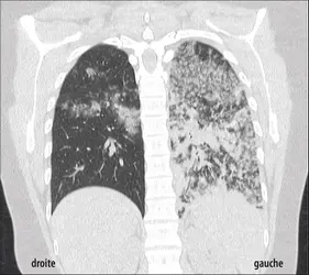 Image radiologique d’une tuberculose pulmonaire - crédits : Grand hôpital de Charleroi, Belgique 