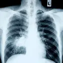 Radiographie pulmonaire dans un cas de pneumonie - crédits : Anthony Ricci/ Shutterstock