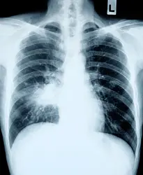 Radiographie pulmonaire dans un cas de pneumonie - crédits : Anthony Ricci/ Shutterstock