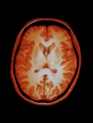 Cerveau humain - crédits : Dr Flavio Dell'Acqua/ Wellcome ; CC BY 4.0