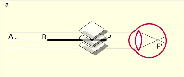 Non-accommodation : œil myope - crédits : Encyclopædia Universalis France