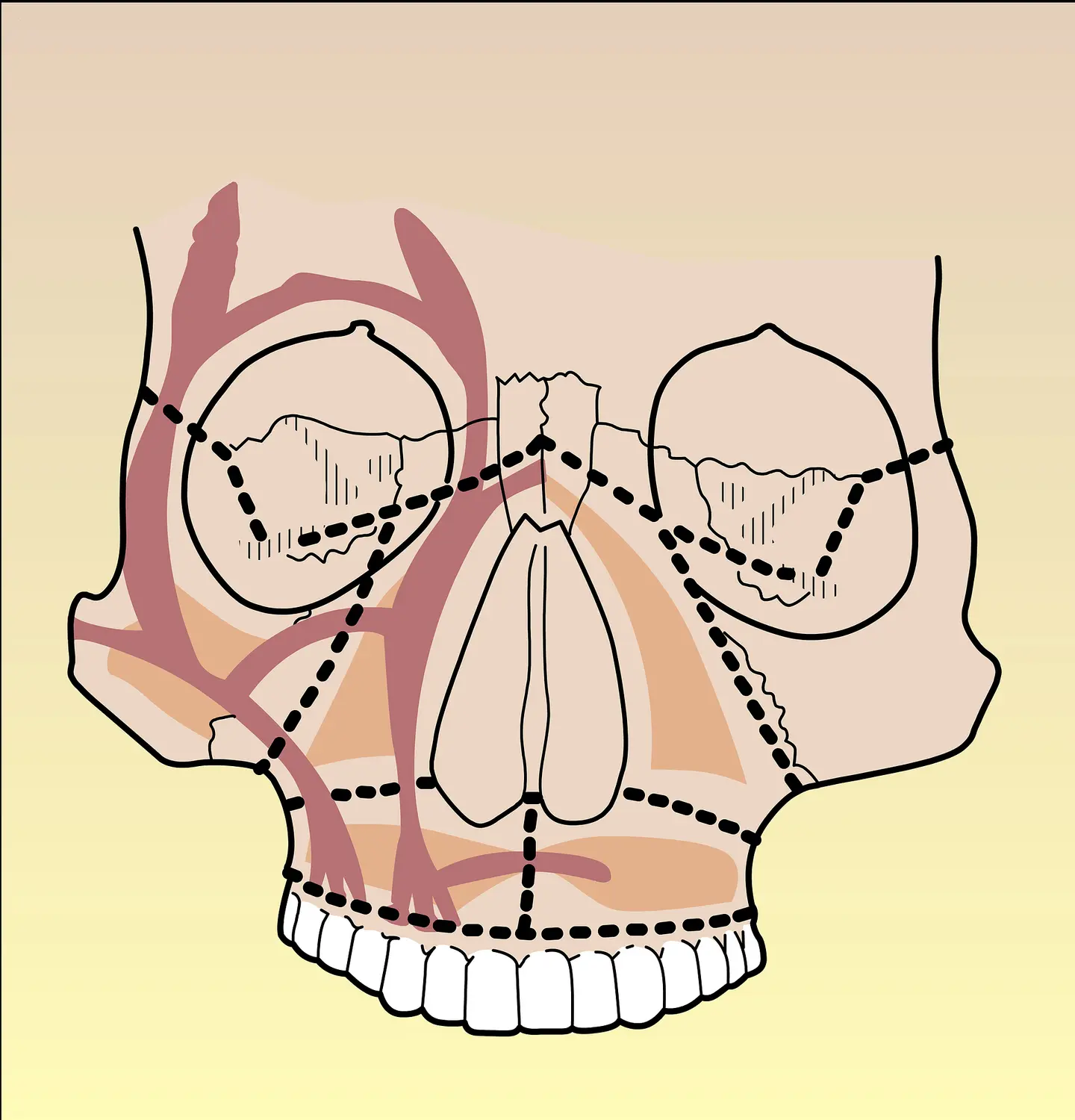 Massif facial