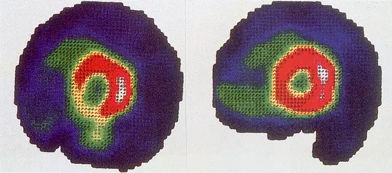 Cardioscintigraphie - crédits : service de médecine nucléaire, hôpital du Haut-Lévêque, Pessac, Gironde