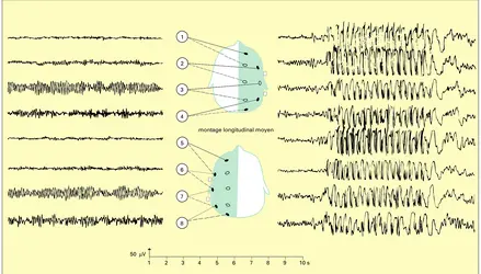 Électro-encéphalogramme - crédits : Encyclopædia Universalis France