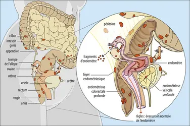 Diversité des foyers d’endométriose - crédits : Encyclopædia Universalis France