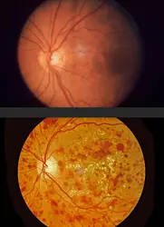 Rétines normale et diabétique - crédits : Lester V. Bergman/ Corbis/ Getty Images (en haut) ; BSIP/ Universal Images Group/ Getty Images (en bas)